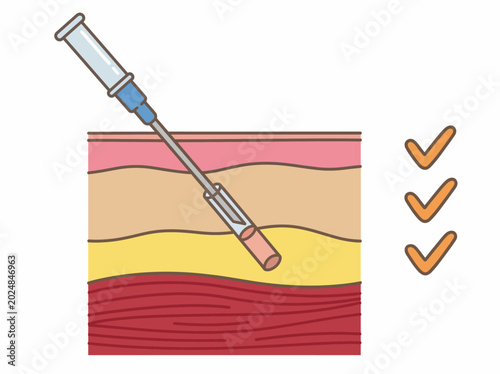 This image illustrates a medical procedure focused on injection technique, capturing essential elements of health, safety, and precision in a clinical setting.
