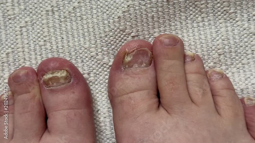 Onychomycosis. Dangerous fungal infection of human toenails on a white background at the doctor. Disease and detachment of the nail plate. Close-up