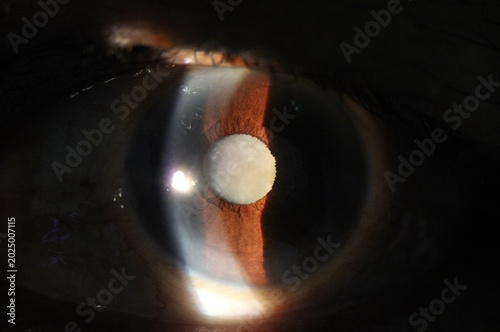 Bilde på lerret Close up of the nuclear senile cataract during slit lamp examination under slit
