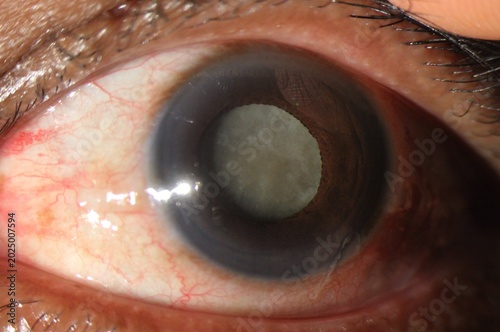 Foto Close up of the senile cataract during slit lamp examination, mature cataract, n