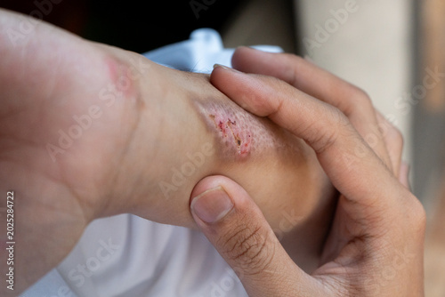 A man suffering from first-degree burn wound on his left hand, his other hand holding the area near the wound