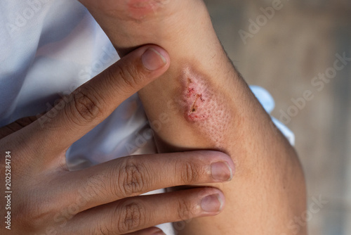 A man suffering from first-degree burn wound on his left hand, his other hand holding the area near the wound