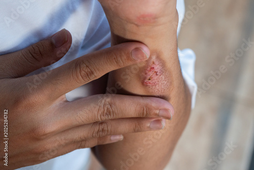 A man suffering from first-degree burn wound on his left hand, his other hand holding the area near the wound