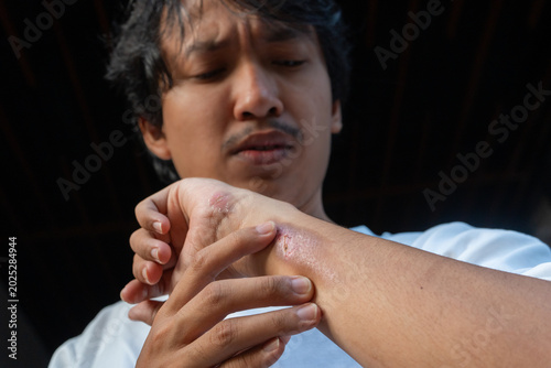 A Southeast Asian man suffering from first-degree burn wound on his left hand, his other hand holding the area near the wound