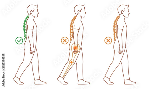Photos Walking Posture Comparison for Spinal Health and Sciatic Nerve Pain