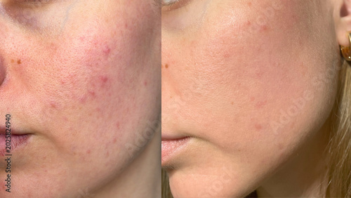 фотографія Side by side comparison of female facial skin before and after acne treatment