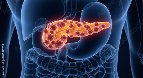 3D medical illustration of pancreatic cancer in a human body