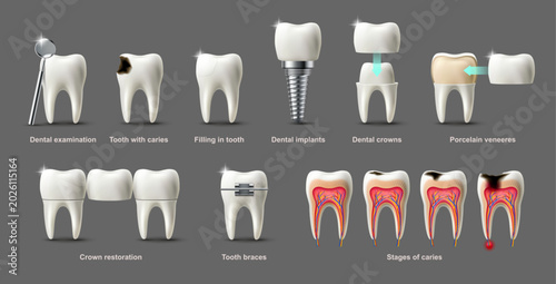 Fotografie Dental tools and procedures including crowns implants caries restoration and exa