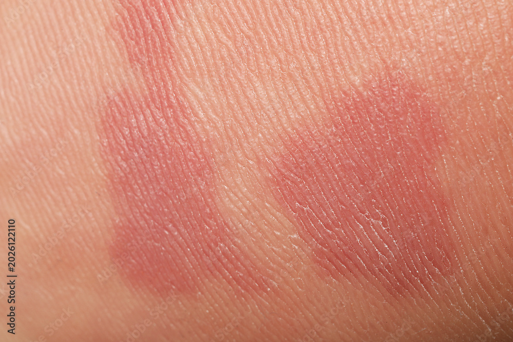 Fototapeta premium Macro view of skin with birthmarks as background