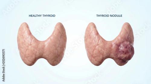 Healthy Thyroid Gland and Thyroid Nodule Tumor Medical Illustration