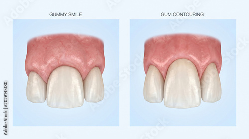 Esthetic Gummy Smile Reduction and Gingivectomy Dental Procedure Illustration