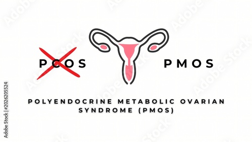 Bild auf Leinwand Polycystic Ovary Syndrome (PCOS) is officially renamed Polyendocrine Metabolic Ovarian Syndrome (PMOS)