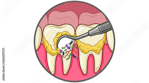 Dental Scaling Procedure with Tartar Removal and Bacteria Illustration