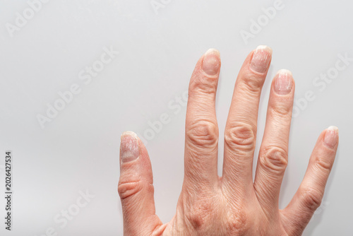 Foto Damaged fingernails with white patches and dry cuticles on fingers close-up