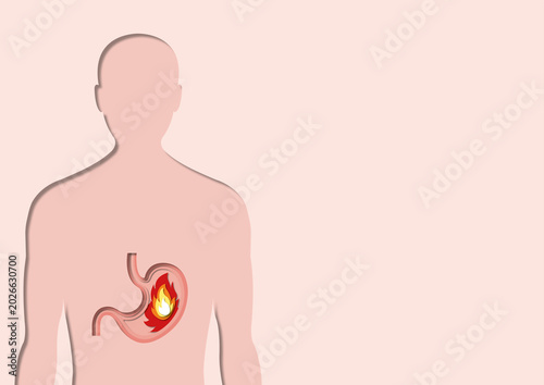 Gastritis, conceptual illustration