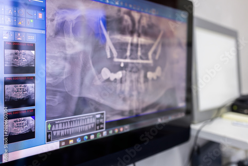 Cuadro en lienzo Dental panoramic radiograph displayed on a clinic monitor, close view of jaw ima