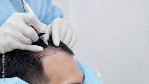 Close-up of surgeon hands using forceps to prepare hair follicle graft in DHI tool.