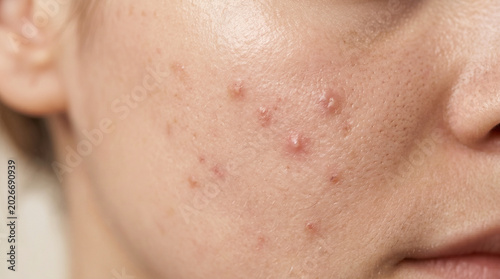Macro photo of mild acne and skin texture