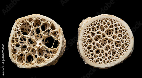 Trabecular bone cross-section comparison: osteoporotic bone with reduced density (left) and normal healthy bone with robust density (right) on black background.