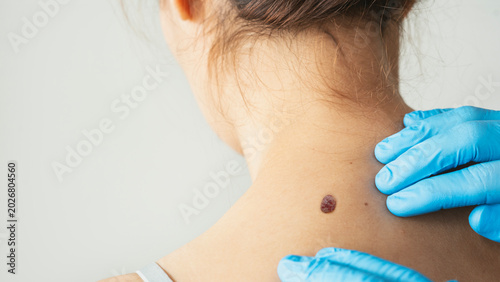 Examining skin for potential cancerous growths