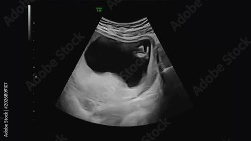 2D Medical Ultrasound Scan of Fetus in Womb During Pregnancy