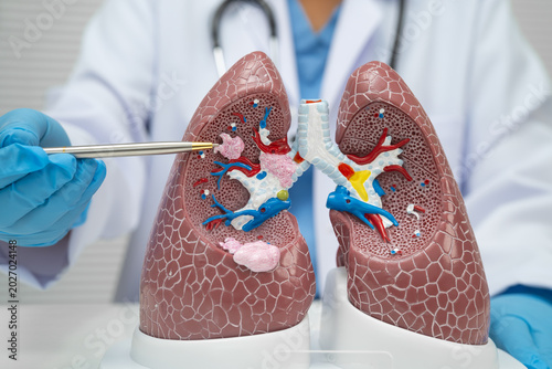 Quadro su tela Pneumonia, lung cancer, Asian doctor with human lung model.