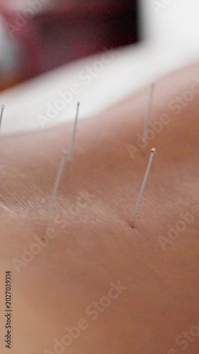 Needles Positioned During Gentle Retention Phase. Scene Showing Needles Nestled On Skin During Therapy Process. Close Examination Of Acupuncture Needles Retained On Skin After Treatment Concludes