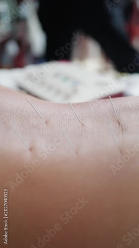 Sterile Environment With Calming Lighting Facilitates Healing Through Acupuncture. Closeup Of Forearm Showing Thin Needles Inserted During Relaxing Acupuncture Session In Clinical Setting
