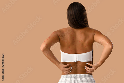 Young woman ill with chicke...