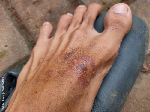 Photos Close up of skin rash, infection, or dermatitis lesion on a human foot