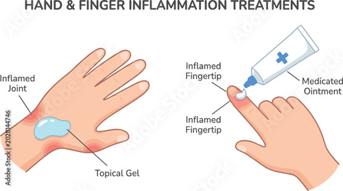 Foto Hand and Finger Inflammation Treatment Diagram Vector Showing Topical Gel Applic
