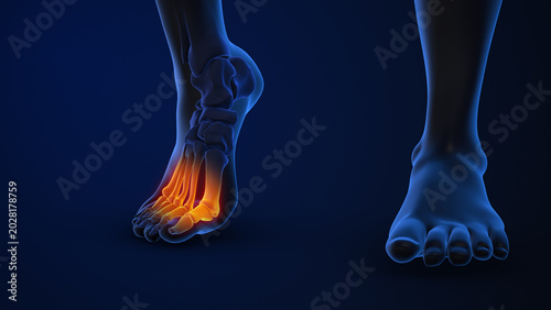 Foto Human forefoot pain affecting metatarsal bone