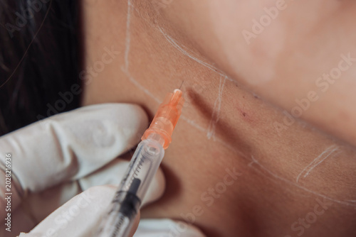 Quadro su tela Female patient receiving mesotherapy injections at an aesthetic clinic below the