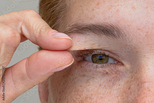 Obraz na plátne Hand pulling the upper eyelid to show the hooded eyelid concept cropped