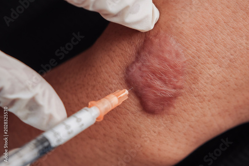 Patient receiving intralesional corticosteroid injection on a hand at an aesthetic clinic for keloid scar reduction and hypertrophic scar treatment