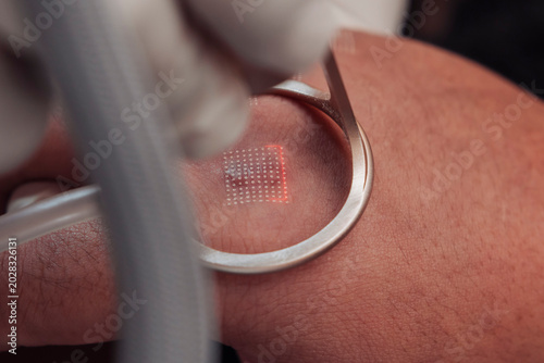 Canvastavla Closeup of fractional carbon dioxide laser treatment at an aesthetic clinic for