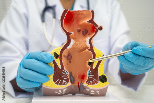 Fotografija Asian doctor with rectum and hemorrhoid human model, inflamed vascular structure