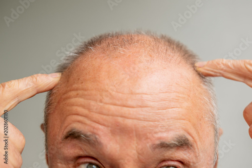 Tableau sur toile Close up senior man 60-65 years old, man's head showing round bald spot on crown