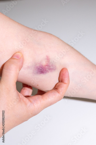 Fotografía bruise on female hand skin, hematoma on elbow area from blood draw, hurt mark, m
