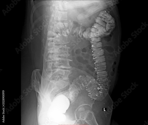 Barium enema X-ray showing multiple diverticula in the colon, diverticulosis.