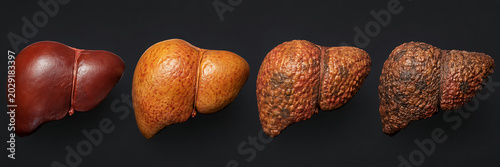 Fatty Liver Progression Timeline Visual