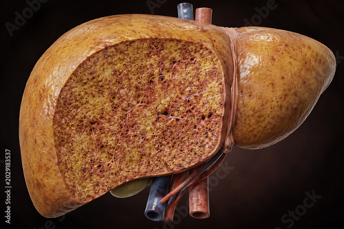 Moderate Fatty Liver Disease Progression cross section 