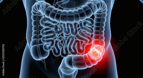 3D Illustration of Colon Cancer or Pain in the Human Intestine