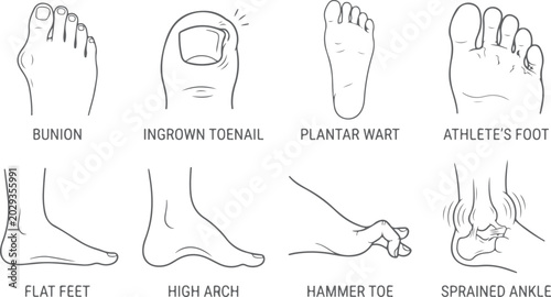 Konstfotografi Common foot conditions bunion ingrown toenail flat feet hammer toe illustration