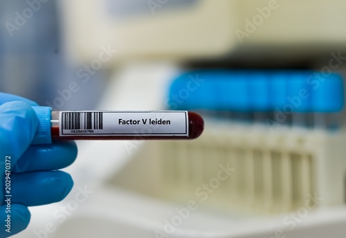 Photos Blood sample tube for factor  V leiden test analysis.
