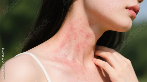 Chronic urticaria is a recurring allergic skin disorder marked by itchy rashes and swollen wheals on human skin. Triggered by immune disorders, allergens and physical stimuli, this persistent skin ail