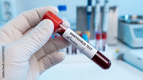 Hand in a medical glove holding a blood sample for a hantavirus test