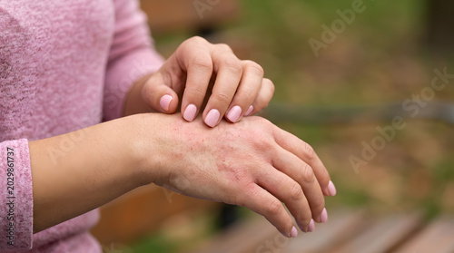 Woman scratching inflamed skin with eczema on hands