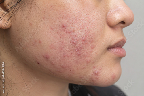 Side View of Moderate Acne Breakout and Red Acne Marks on Female Cheek