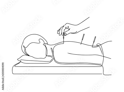 Acupuncture therapy session. Continuous line art illustration of patient receiving treatment. Vector graphic isolated on white background